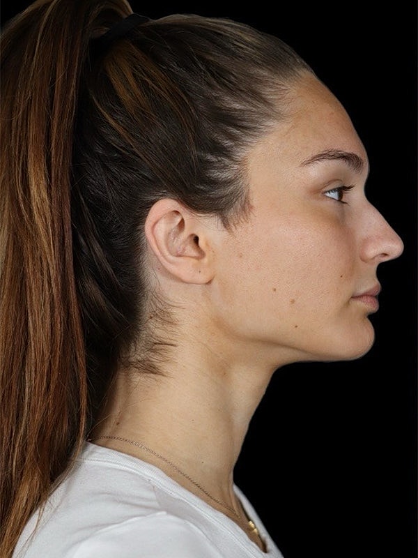 Liquid Rhinoplasty Before & After