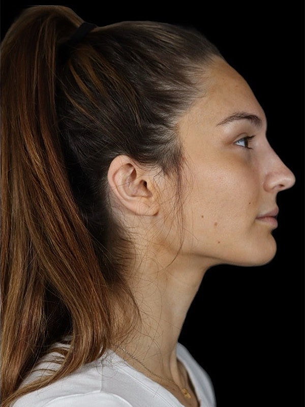 Liquid Rhinoplasty Before & After