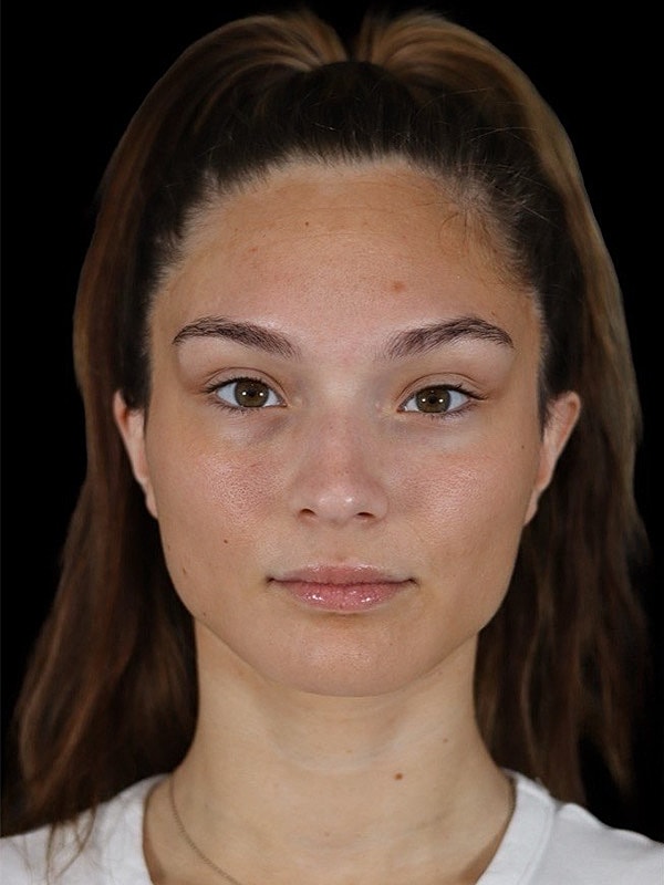 Liquid Rhinoplasty Before & After