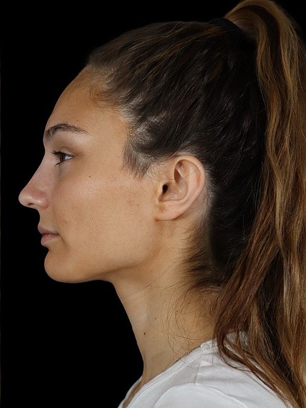 Liquid Rhinoplasty Before & After