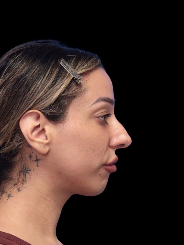 Chin Augmentation Before & After