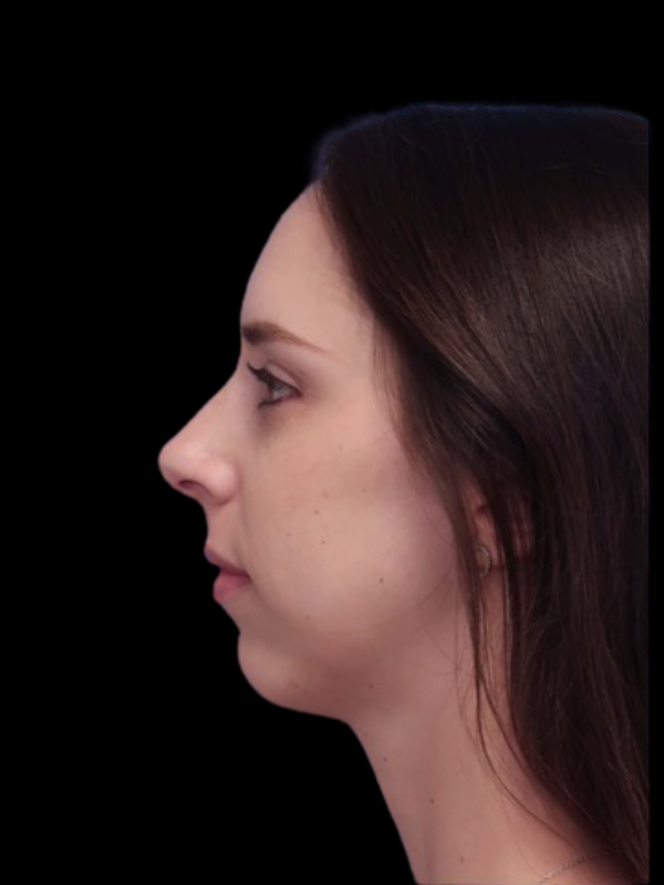 Chin Augmentation Before & After