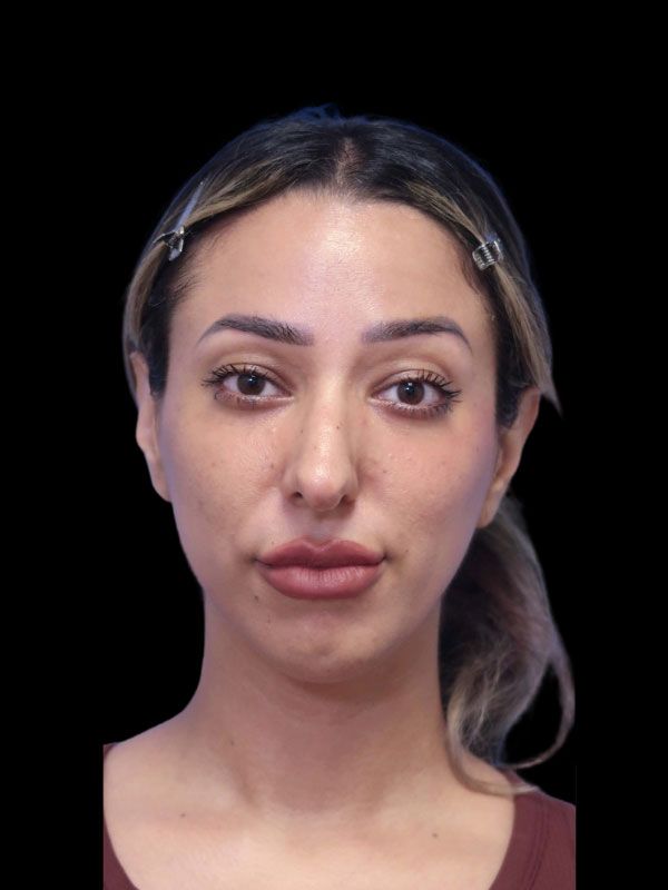 Chin Augmentation Before & After