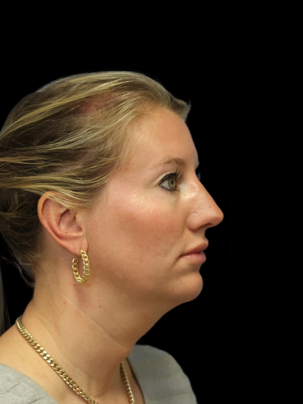 Chin Augmentation Before & After