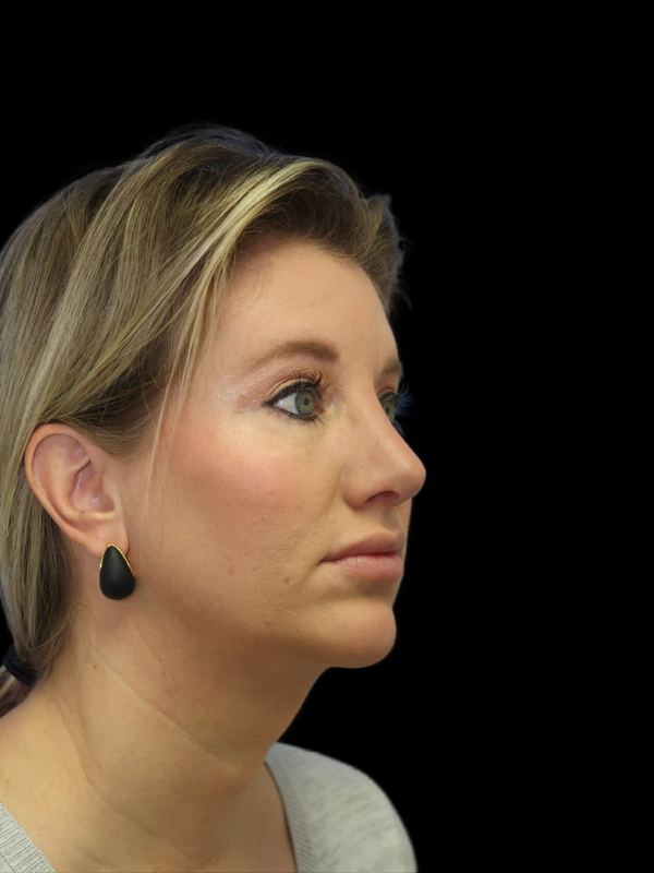 Chin Augmentation Before & After