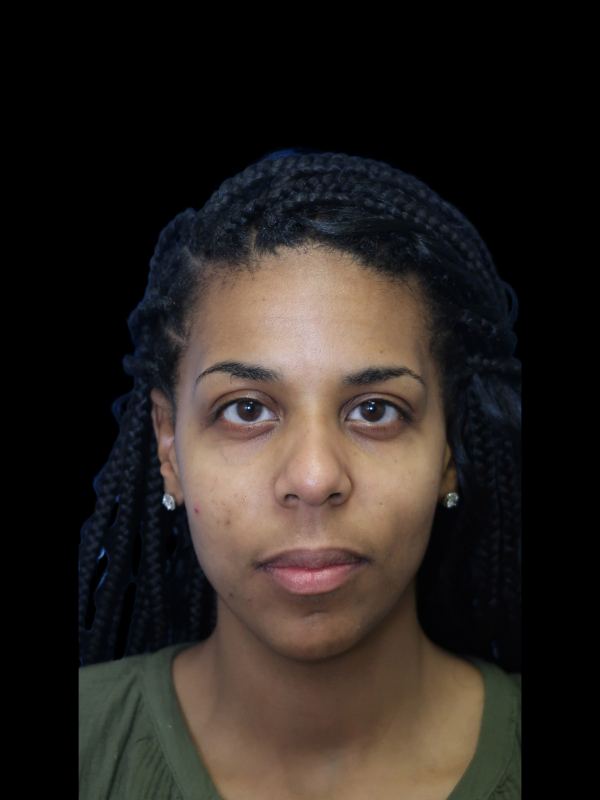 Chin Augmentation Before & After