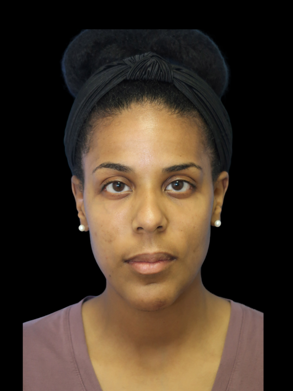 Chin Augmentation Before & After