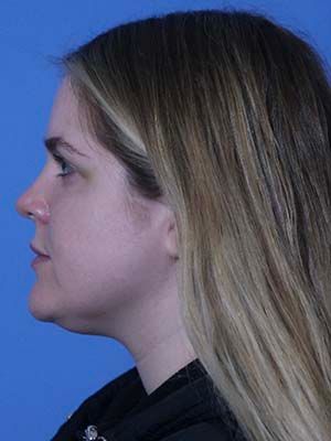 Neck Liposuction Before & After