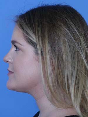 Neck Liposuction Before & After