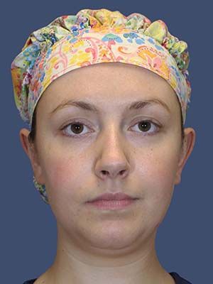 Neck Liposuction Before & After