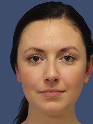 Neck Liposuction Before & After