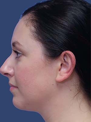 Neck Liposuction Before & After