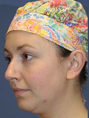 Neck Liposuction Before & After