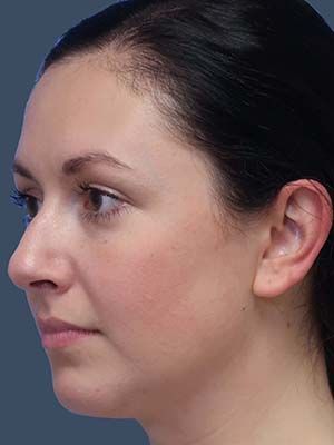 Neck Liposuction Before & After