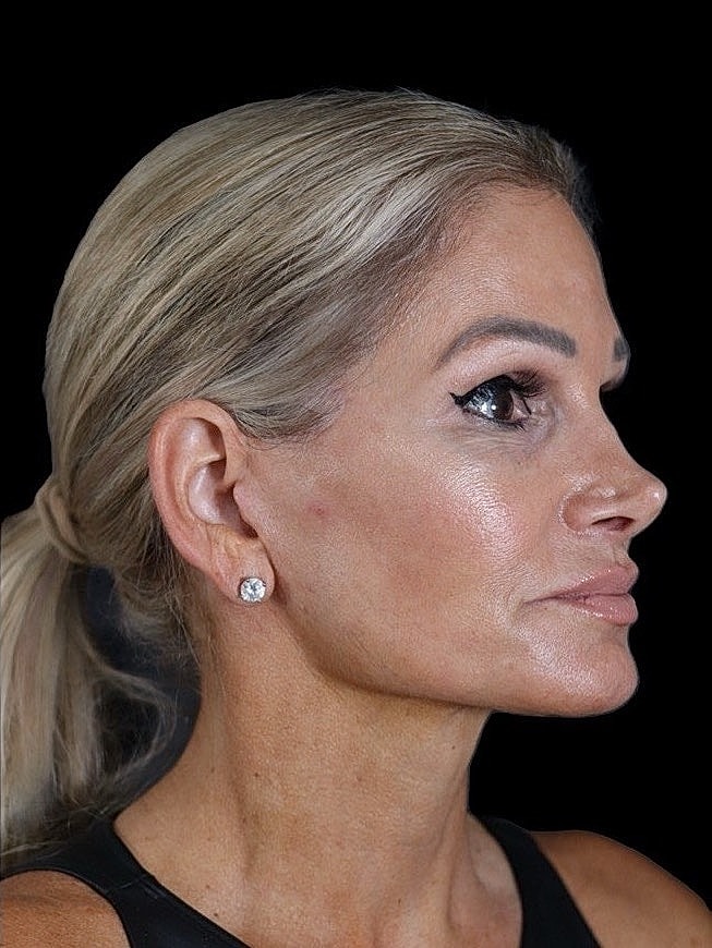 Deep Plane Facelift Gallery Before & After
