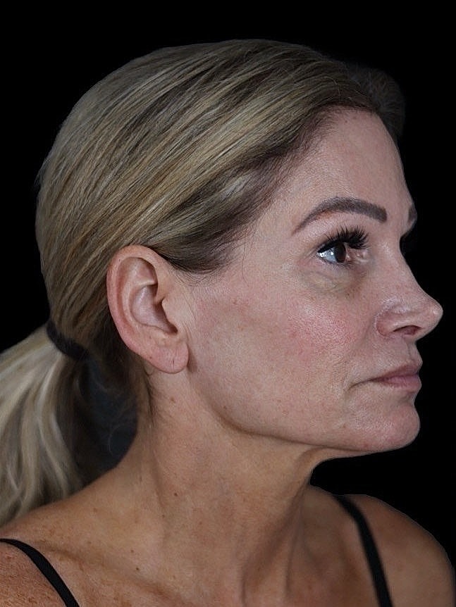 Deep Plane Facelift Gallery Before & After