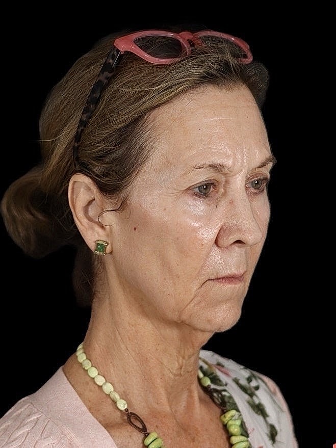 Deep Plane Facelift Gallery Before & After