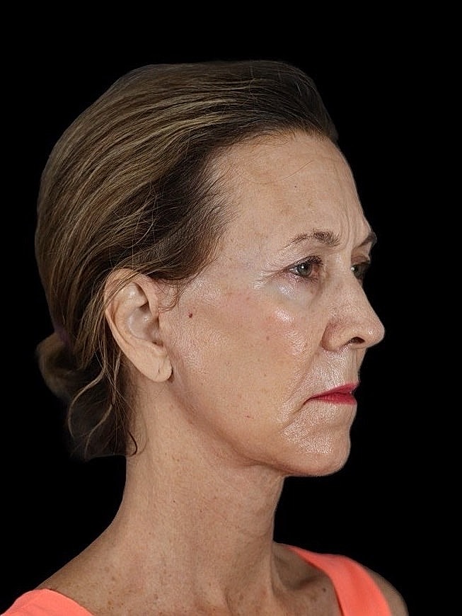 Deep Plane Facelift Gallery Before & After