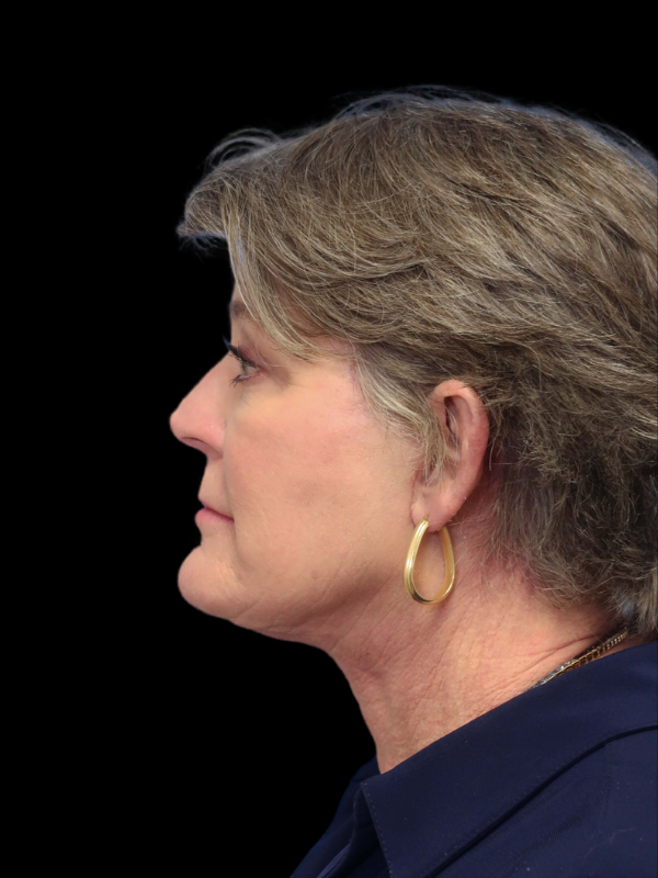 Deep Plane Facelift Gallery Before & After