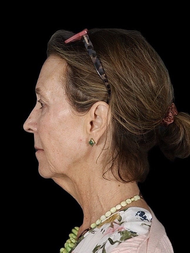 Deep Plane Facelift Gallery Before & After