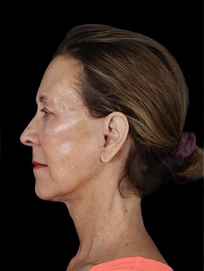 Deep Plane Facelift Gallery Before & After