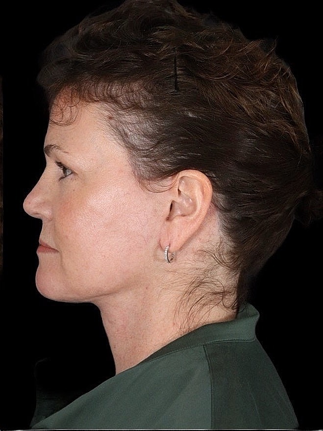 Deep Plane Facelift Gallery Before & After