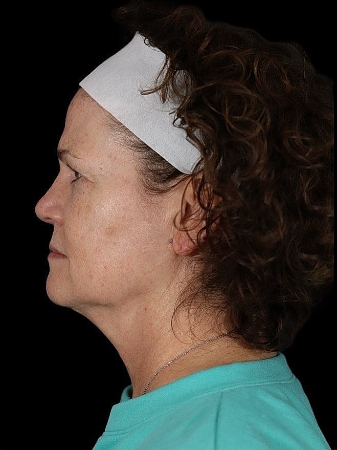 Deep Plane Facelift Gallery Before & After