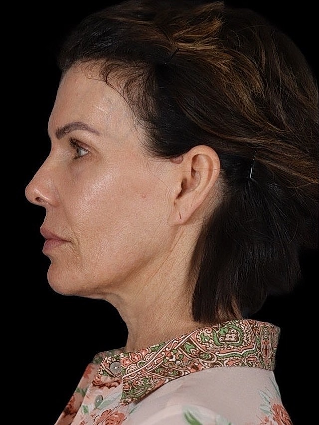 Deep Plane Facelift Gallery Before & After