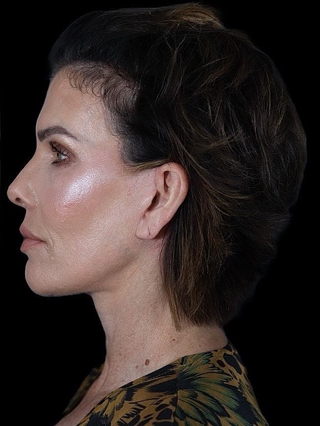 Deep Plane Facelift Gallery Before & After