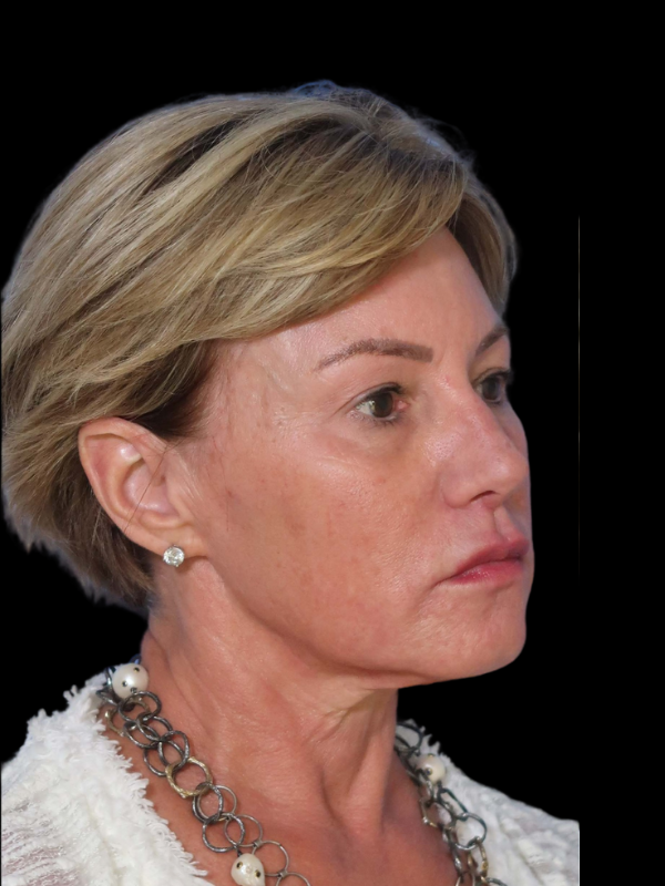 Deep Plane Facelift Gallery Before & After