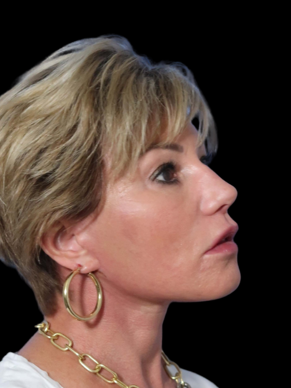 Deep Plane Facelift Gallery Before & After