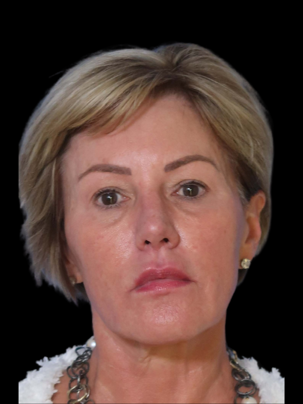 Deep Plane Facelift Gallery Before & After