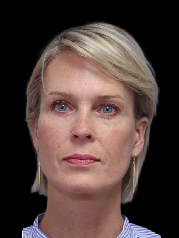 Deep Plane Facelift Gallery Before & After