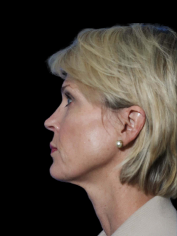 Deep Plane Facelift Gallery Before & After