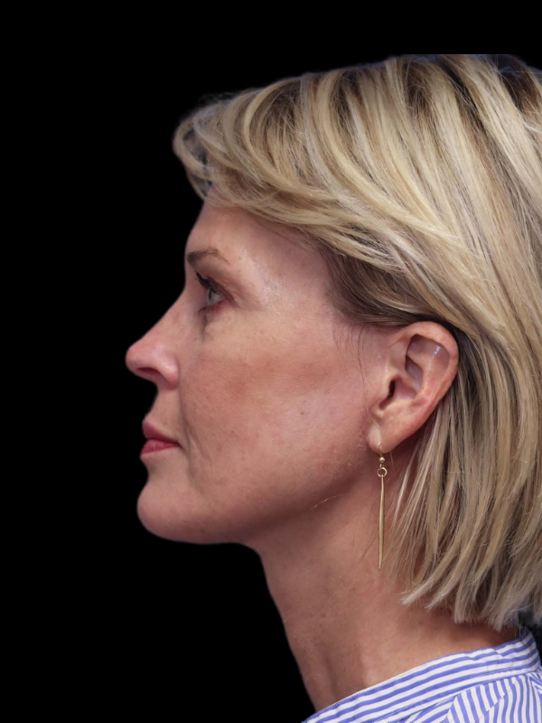 Deep Plane Facelift Gallery Before & After