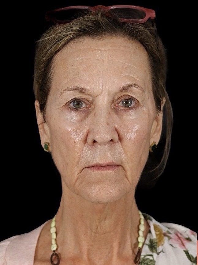 Deep Plane Facelift Gallery Before & After