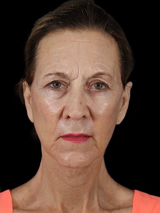 Deep Plane Facelift Gallery Before & After