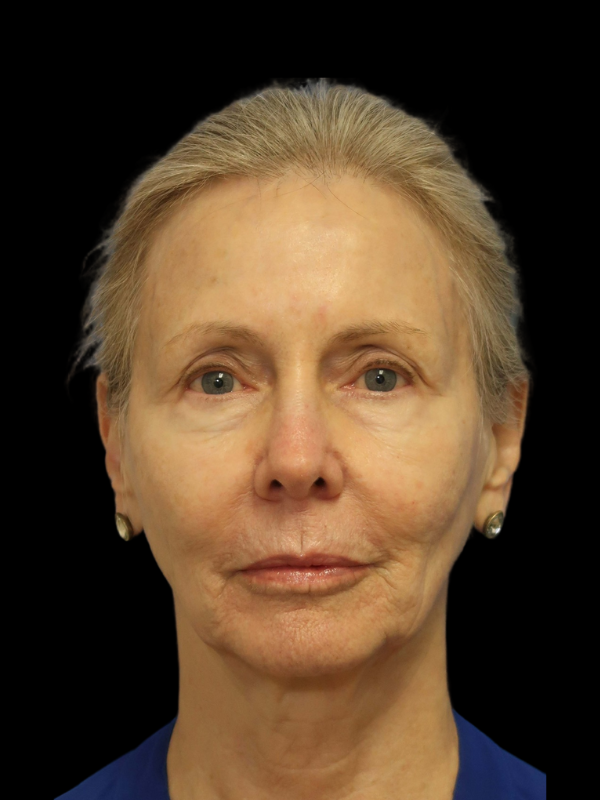 Deep Plane Facelift Gallery Before & After
