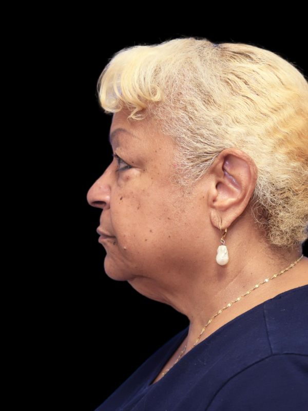 Deep Plane Facelift Gallery Before & After