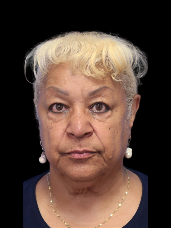 Deep Plane Facelift Gallery Before & After