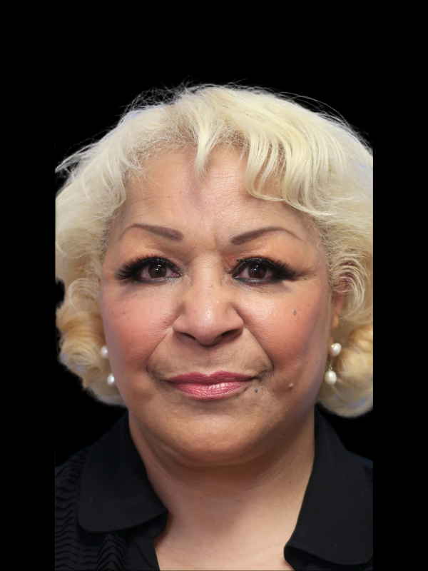 Deep Plane Facelift Gallery Before & After