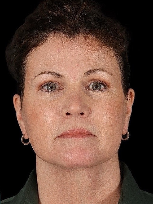 Deep Plane Facelift Gallery Before & After