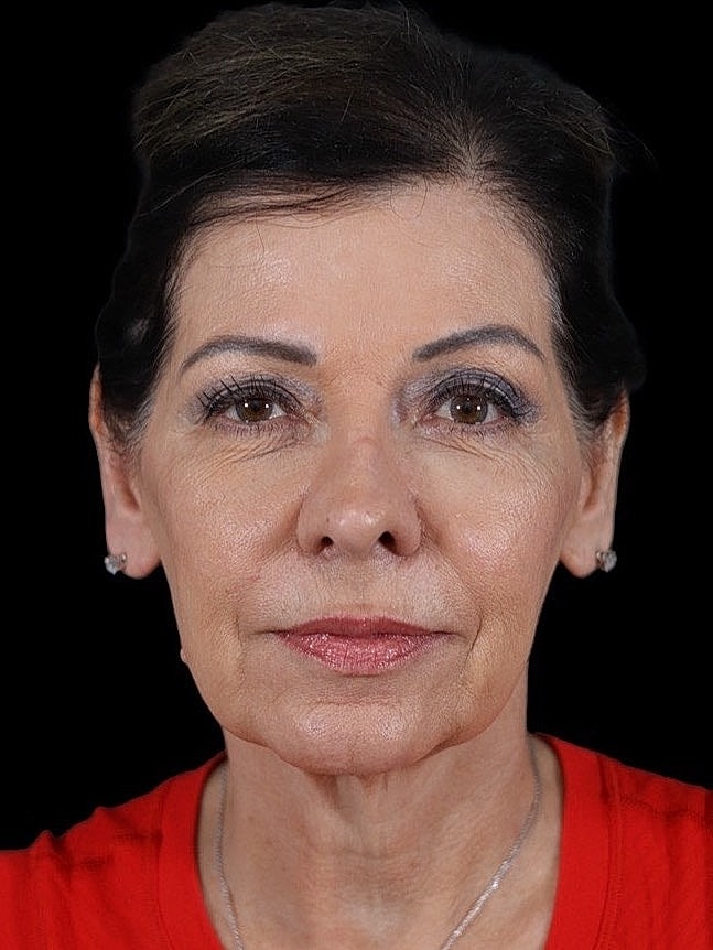 Deep Plane Facelift Gallery Before & After