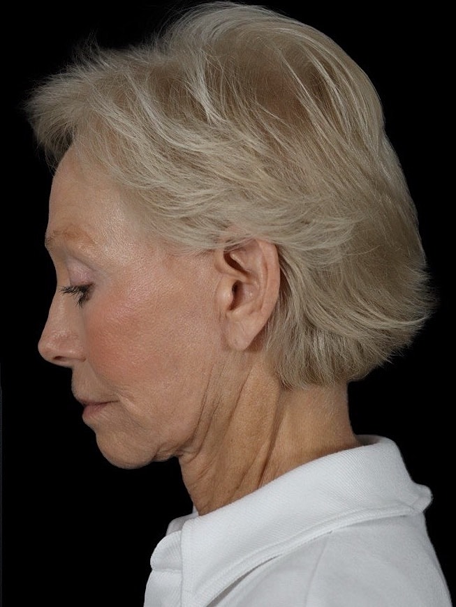 Deep Plane Facelift Gallery Before & After