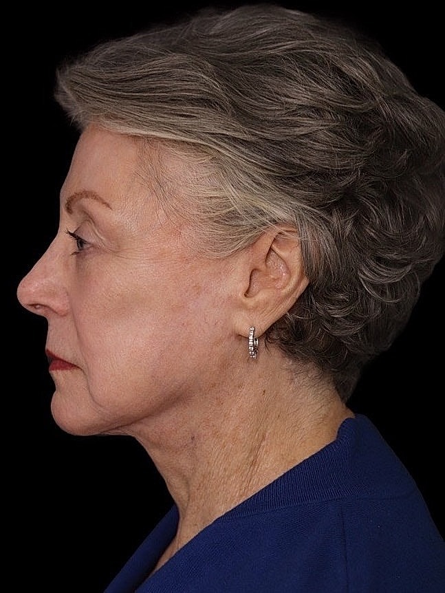 Deep Plane Facelift Gallery Before & After