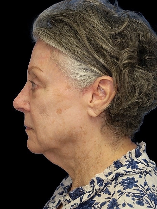 Deep Plane Facelift Gallery Before & After