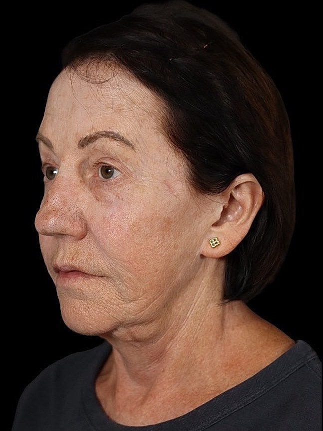 Deep Plane Facelift Gallery Before & After
