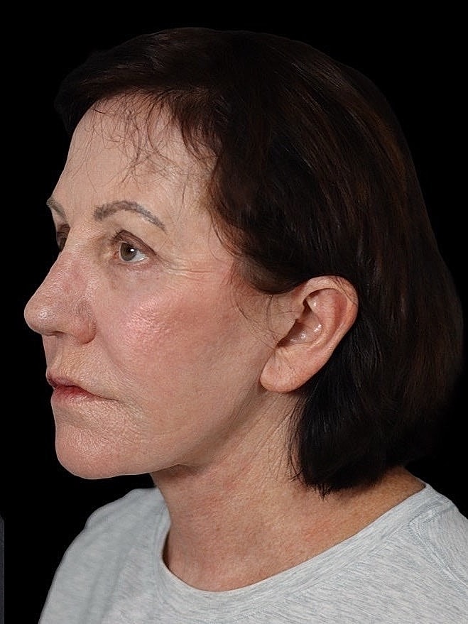 Deep Plane Facelift Gallery Before & After