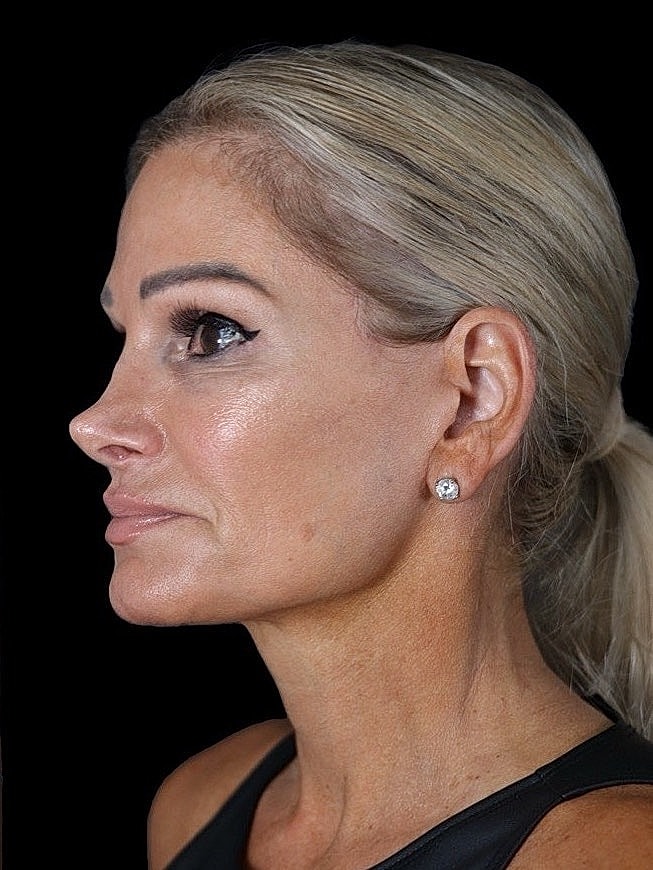 Deep Plane Facelift Gallery Before & After
