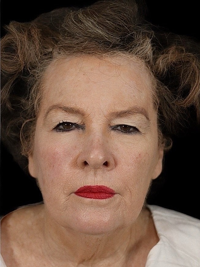 Deep Plane Facelift Gallery Before & After